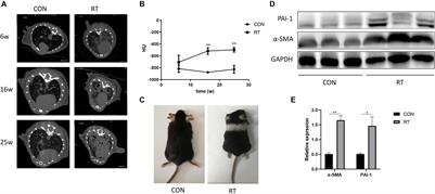 Aerosolized Thyroid Hormone Prevents Radiation Induced Lung Fibrosis